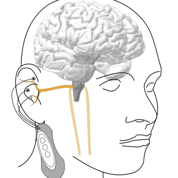 Nervenstimulation: Wenn das Gehirn nicht immer zuhört